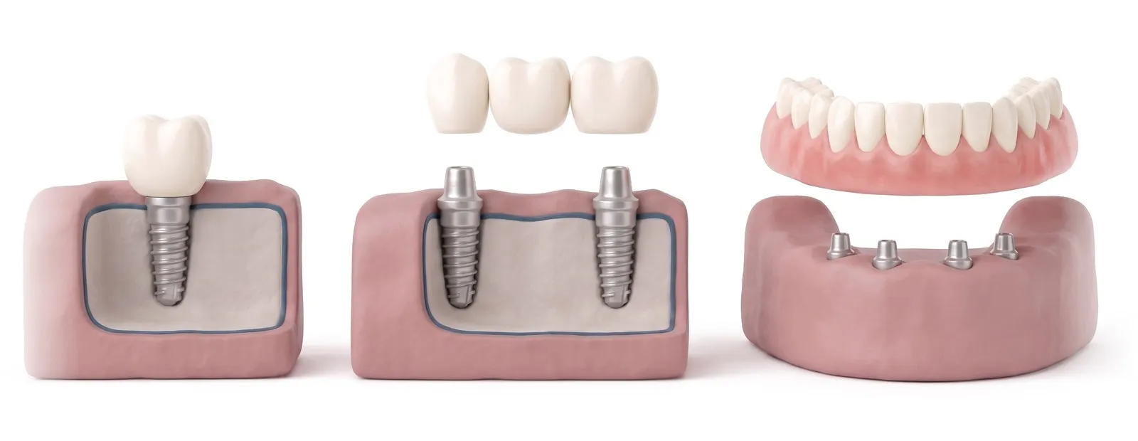 Tri modela čeljusti: krunica na jednom implantatu, most na dva implantata i proteza iznad četiri implantata